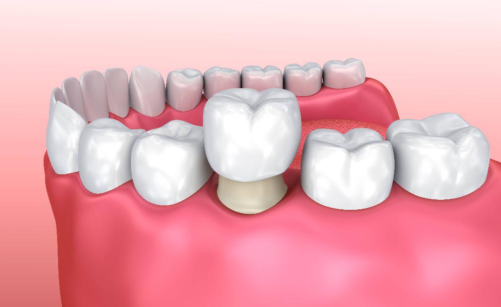 An Image illustration of Same-Day Crowns in Rockville, MD